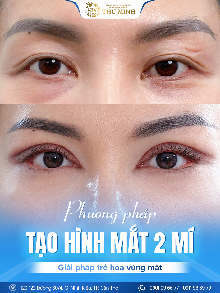 Thẩm mỹ vùng mắt