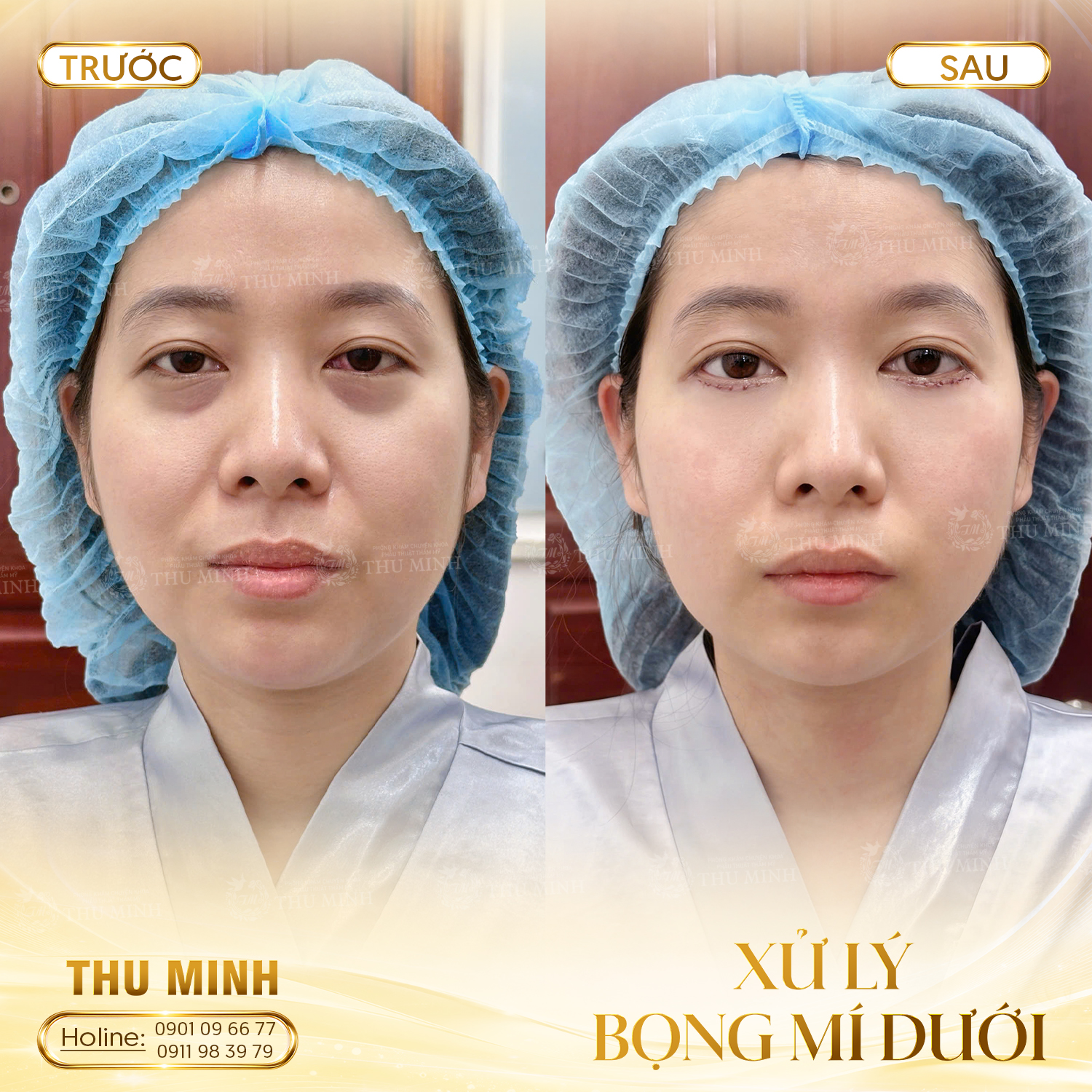 XỬ LÝ BỌNG MÍ DƯỚI 1