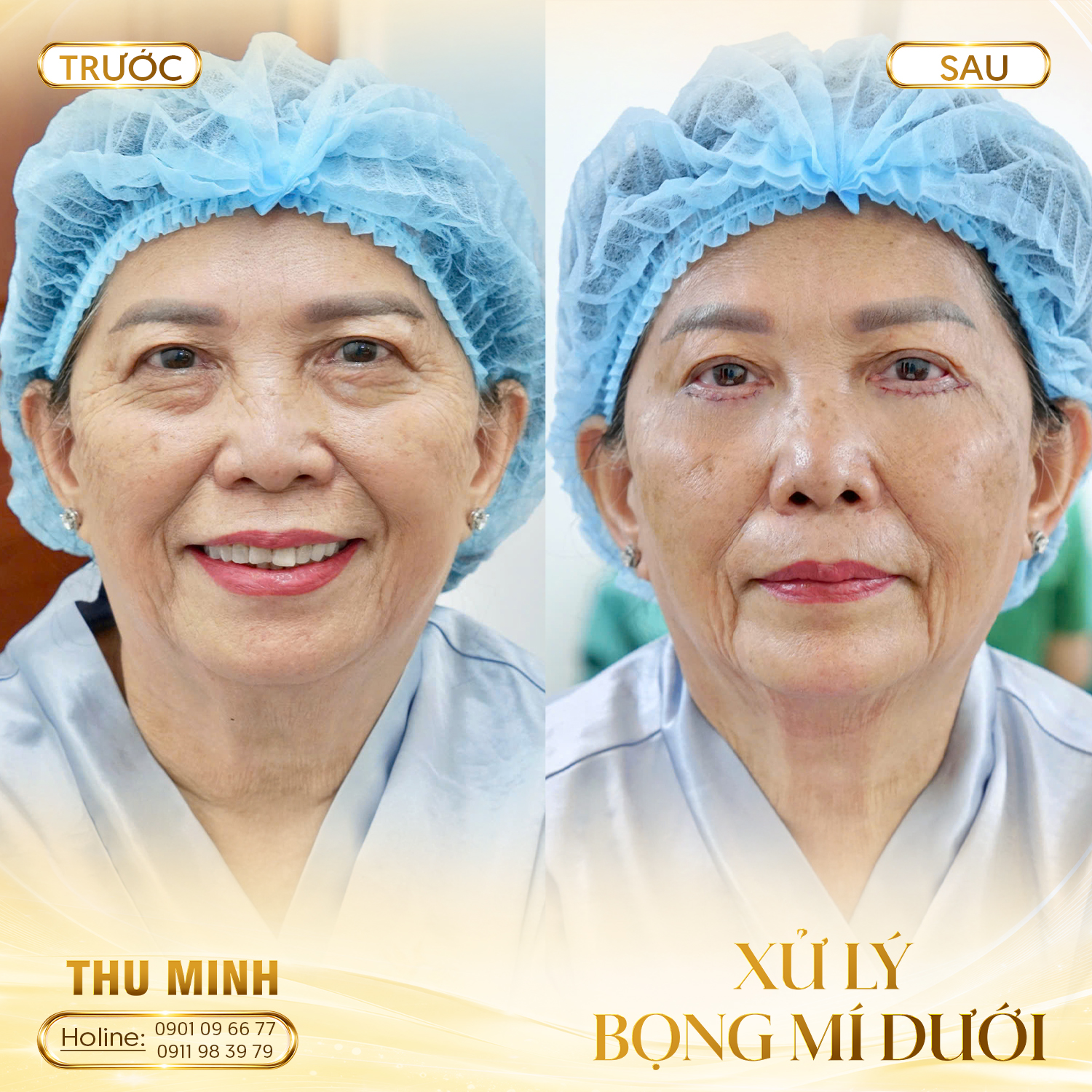 XỬ LÝ BỌNG MÍ DƯỚI 2