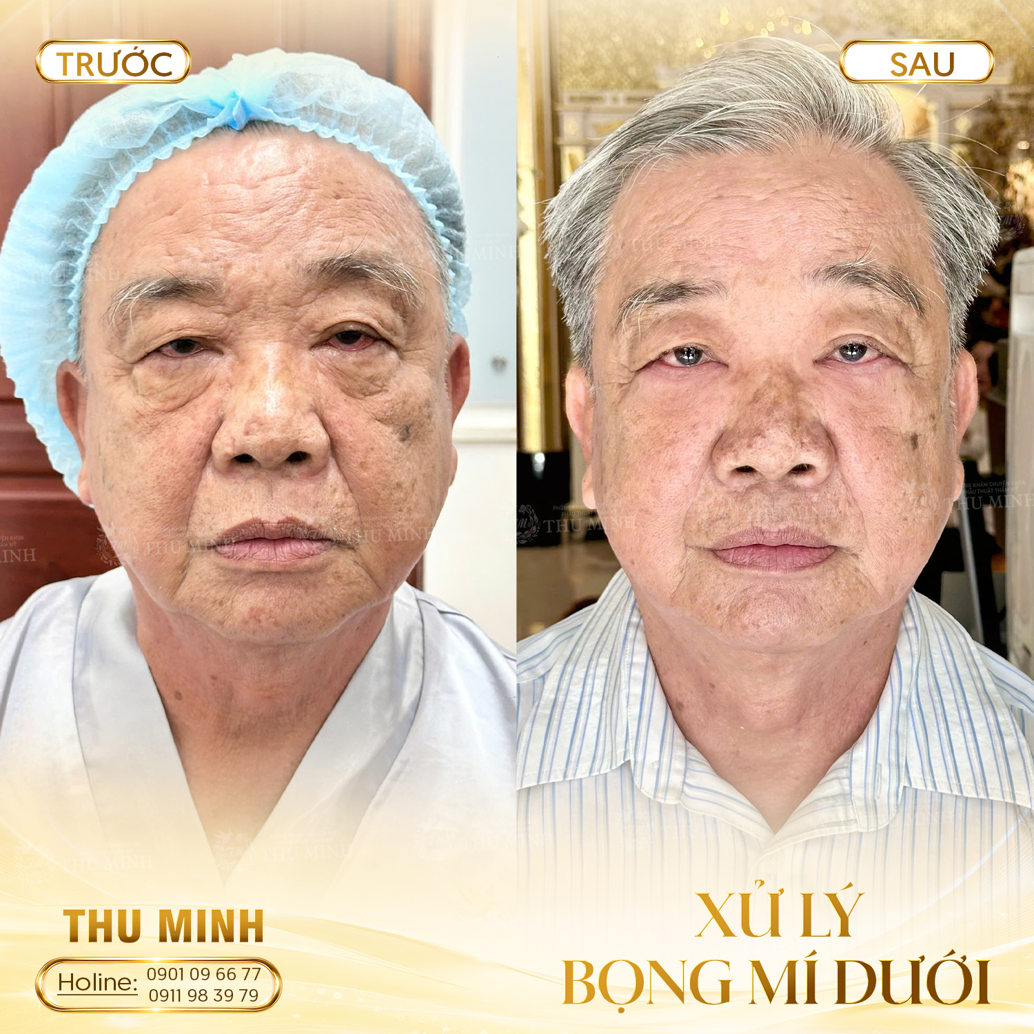 XỬ LÝ BỌNG MÍ DƯỚI 3