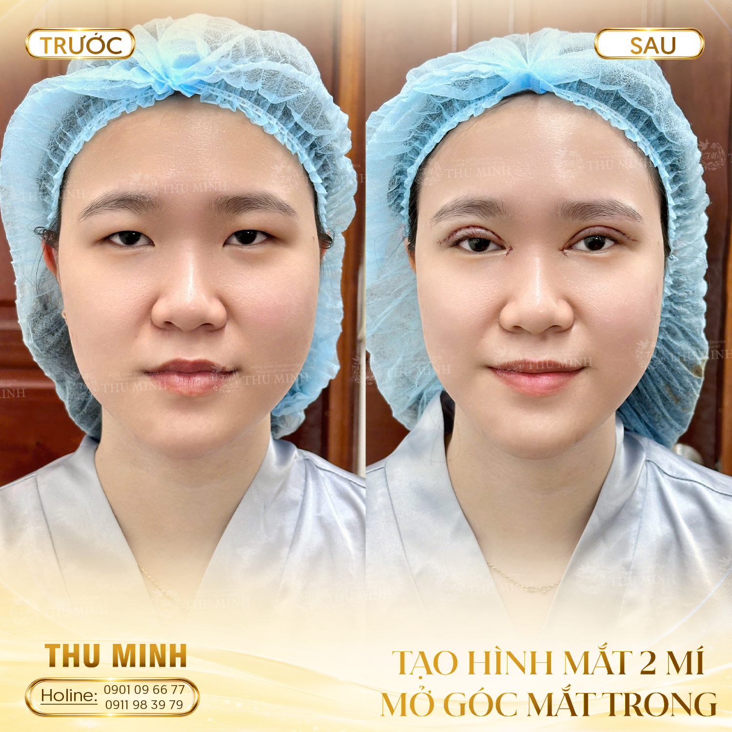 Tạo hình mắt hai mí & nâng cung mày