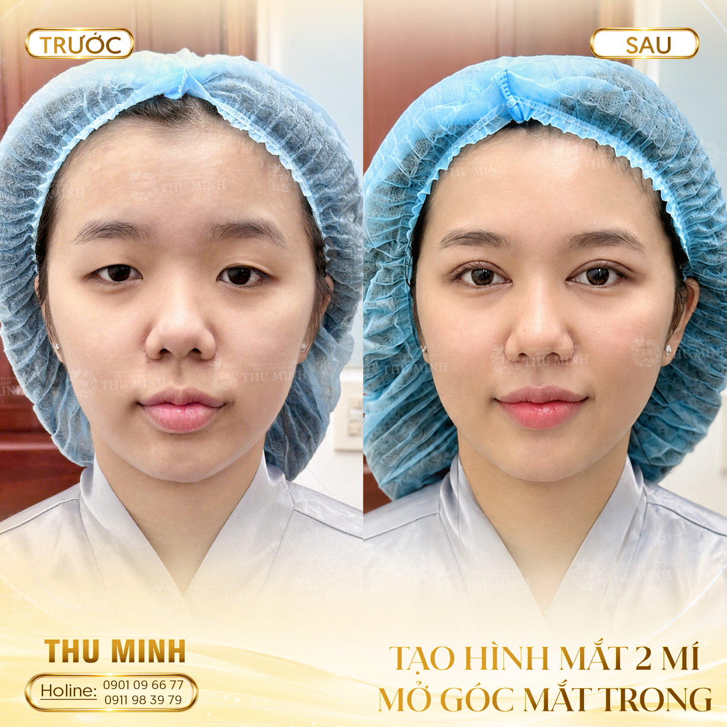 Tạo hình mắt hai mí & mở góc trong
