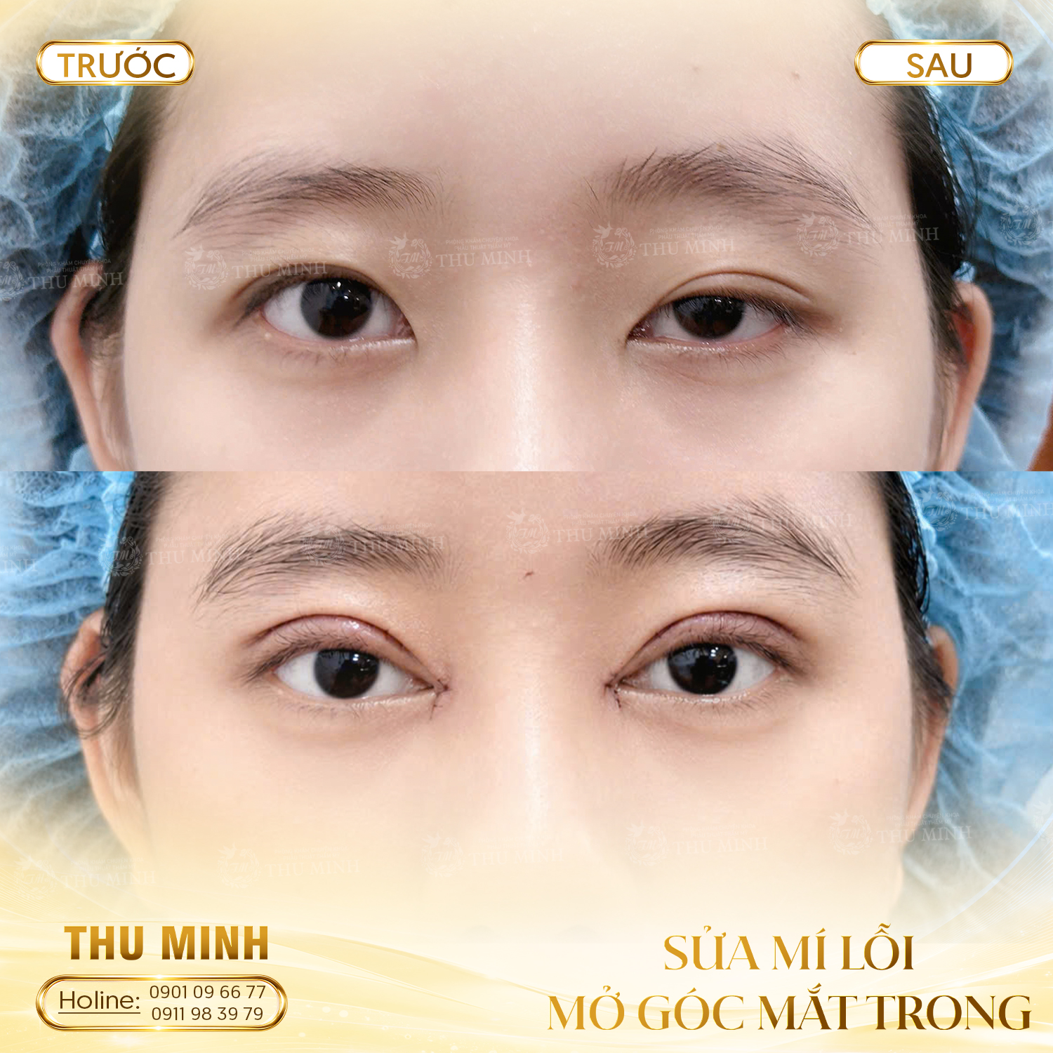 Xử lý bọng mí dưới & nâng cung mày