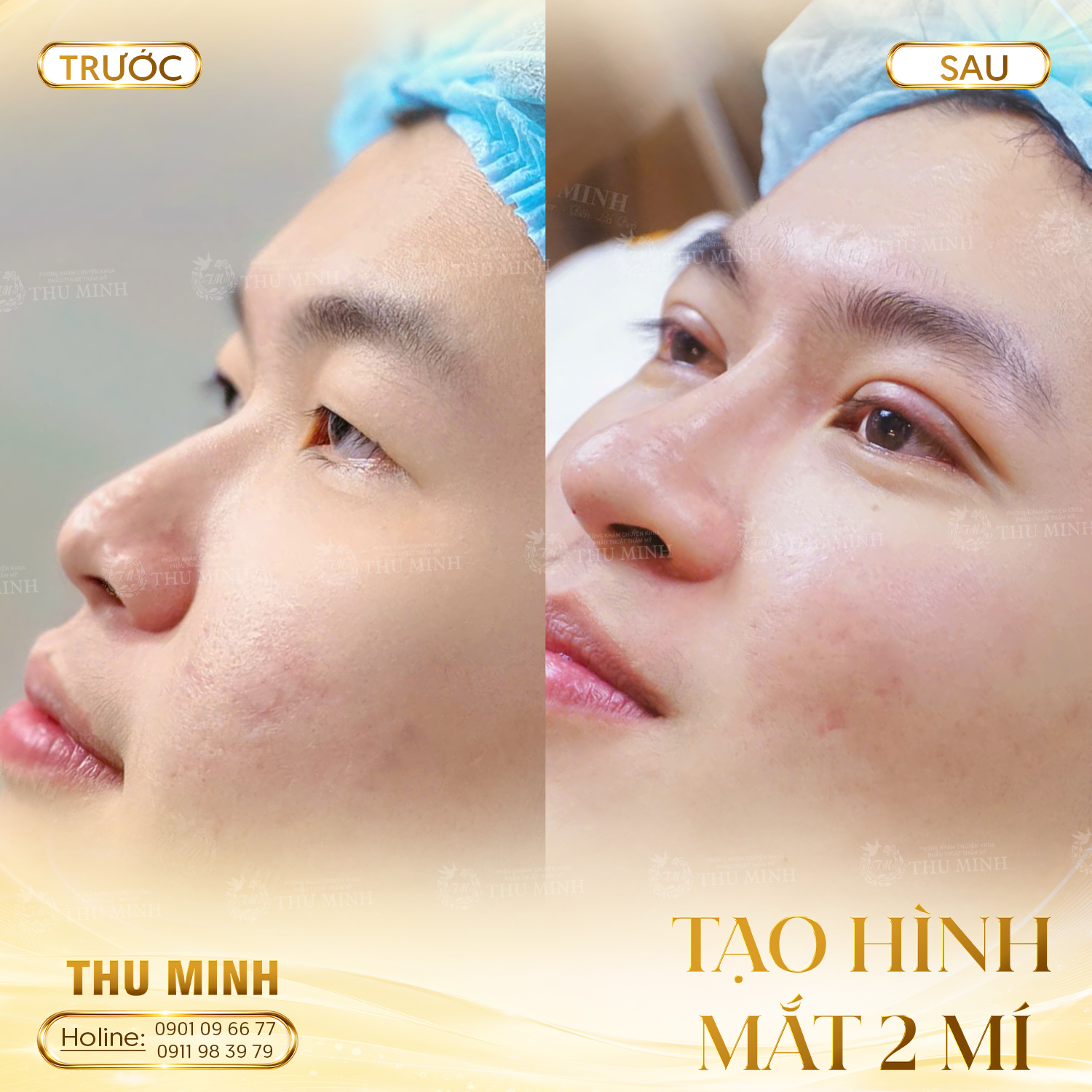 TẠO HÌNH MẮT 2 MÍ 3