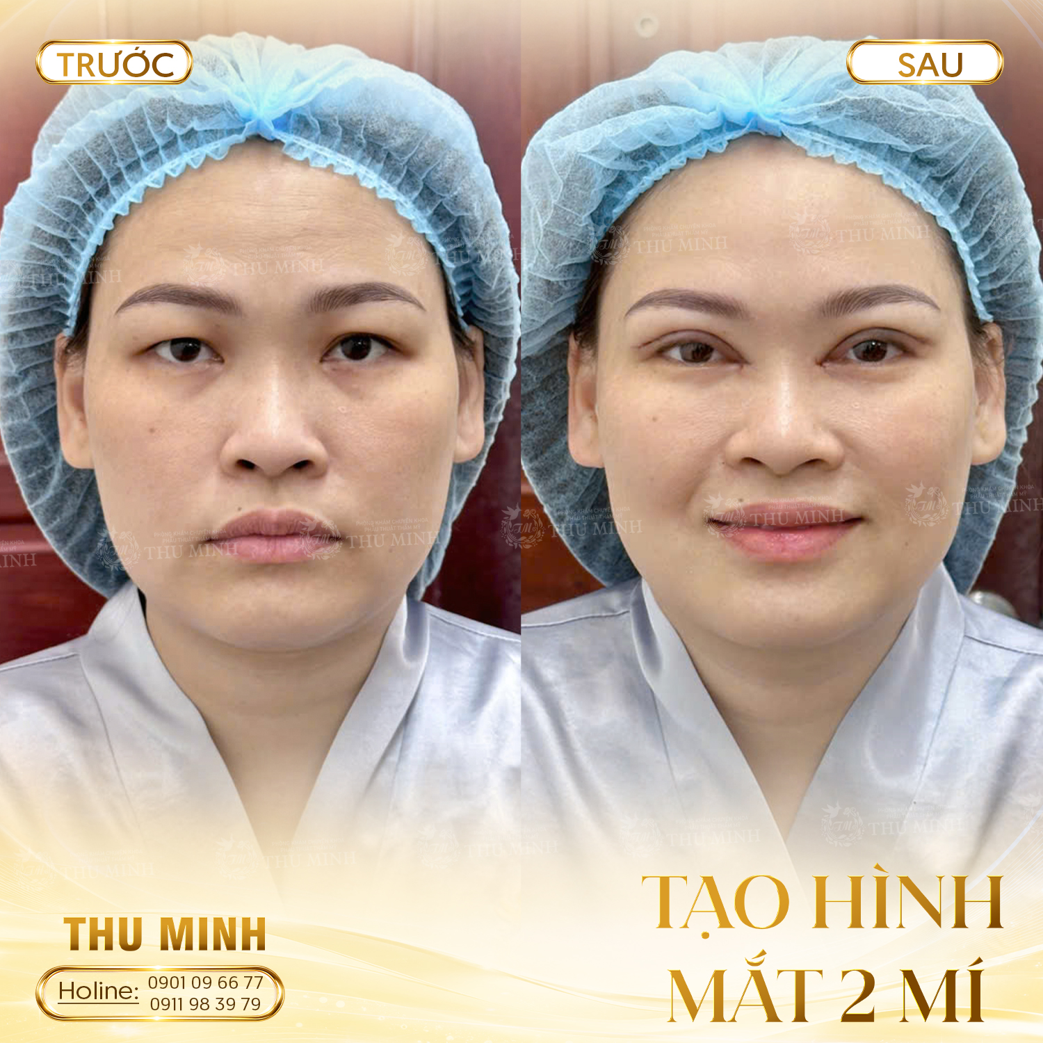 TẠO HÌNH MẮT 2 MÍ 2