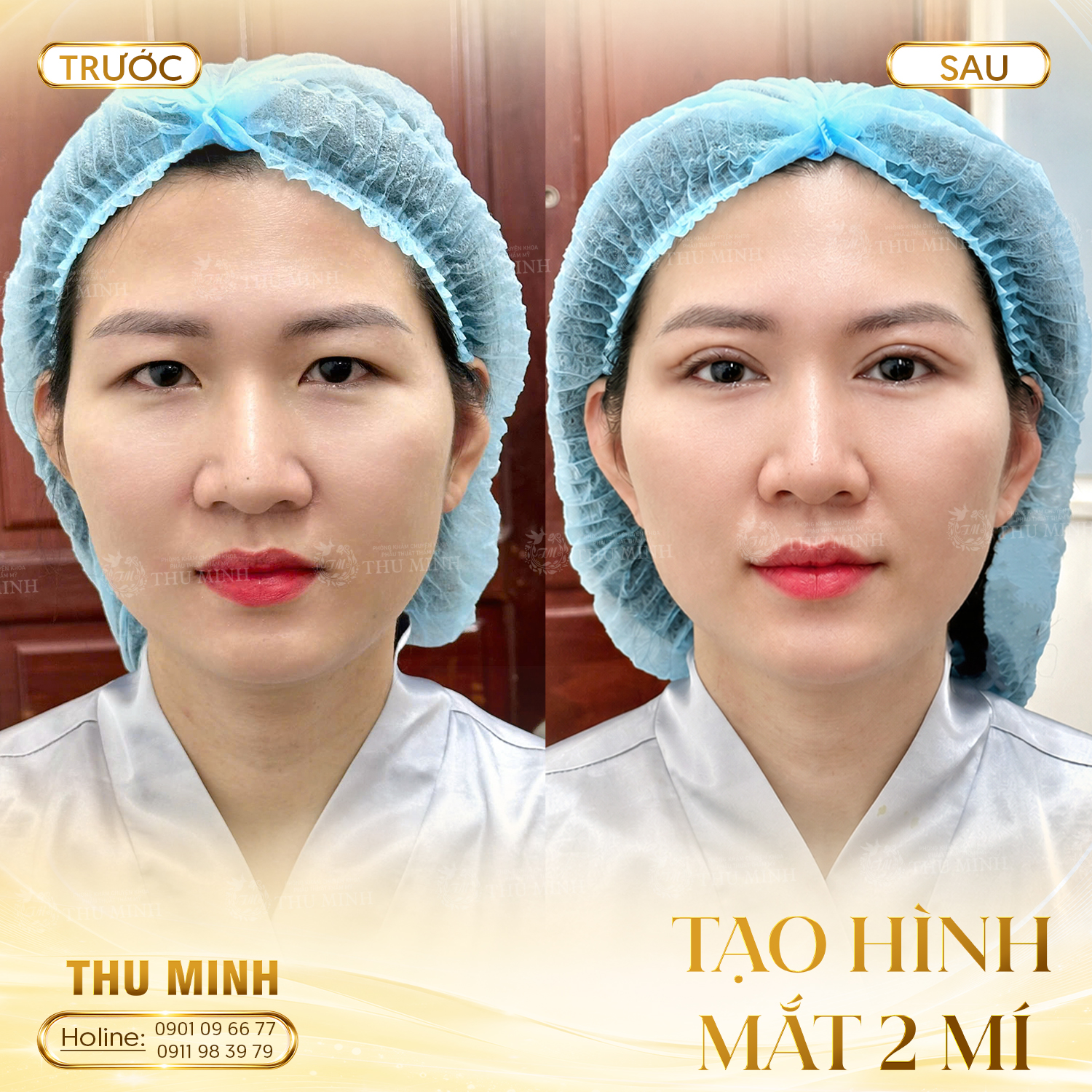TẠO HÌNH MẮT 2 MÍ 1